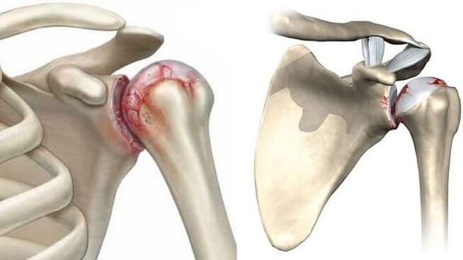 sorbalda artikulazioko lesioa artrosiaren ondorioz