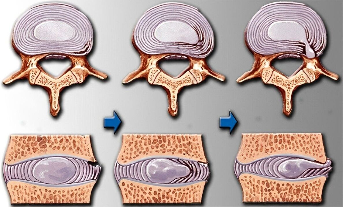 osteokondrosiaren faseak