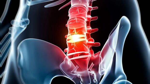 Lumbar bizkarrezurraren osteokondrosia